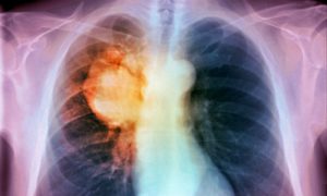 Tumore al polmone